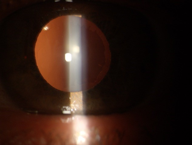 Glaucoma pseudosfogliato