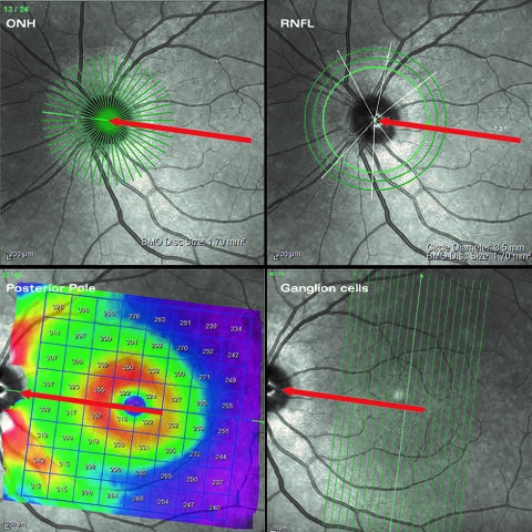 OCT glaucoma